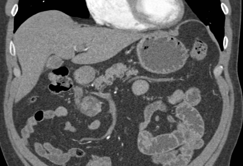 Neuroendocrine Tumor in Head of Pancreas - CTisus CT Scan