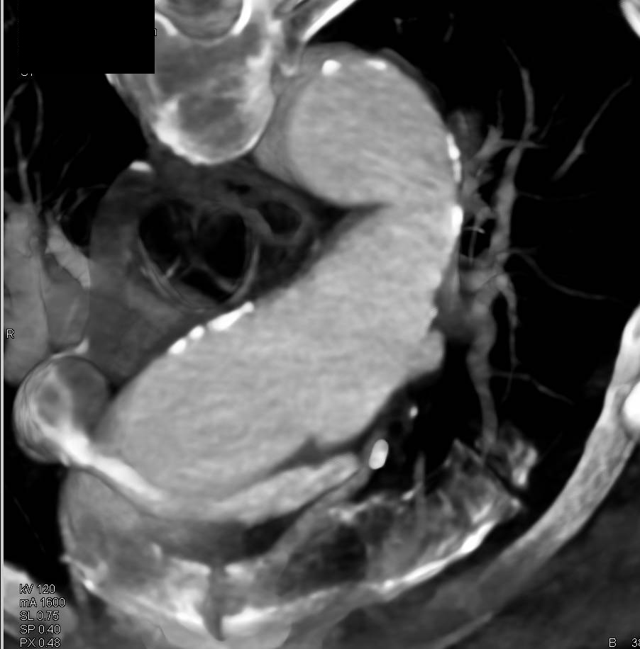 Ulceration in Aortic Arch - CTisus CT Scan