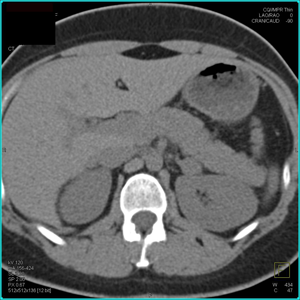 Left Adrenal Adenoma with Classic Washout Study - CTisus CT Scan