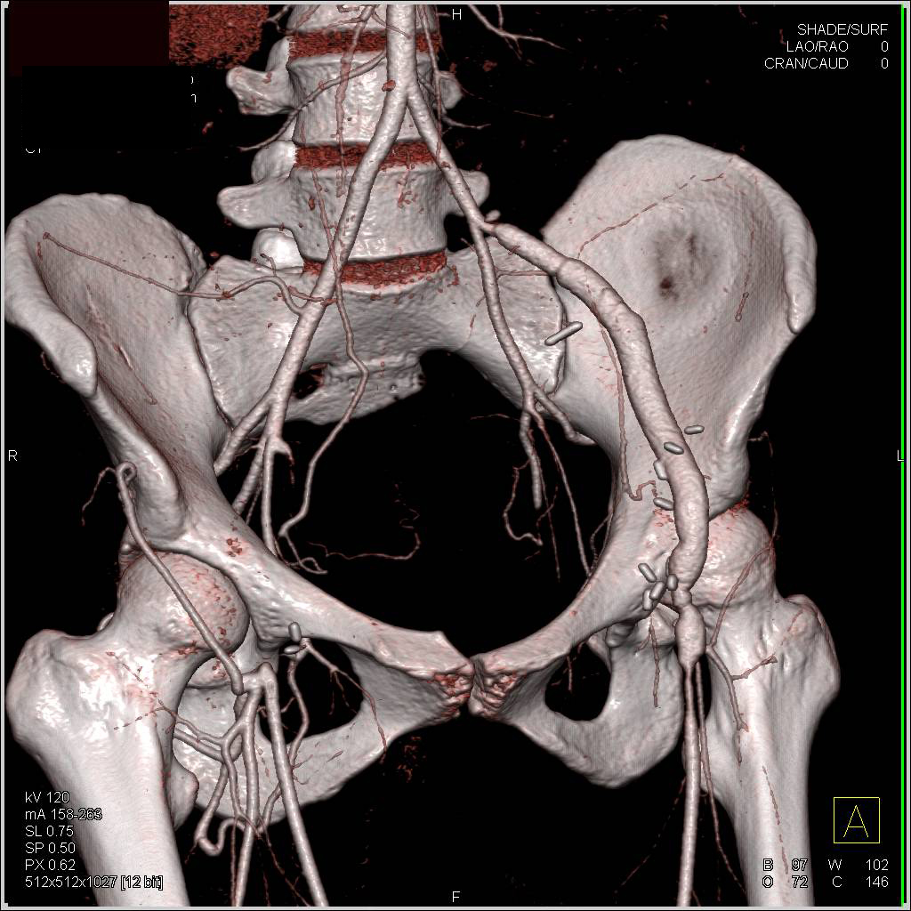 Unusual Vascular Graft from Left Iliac Artery with Stenosis and 3D Vascular Mapping - CTisus CT Scan