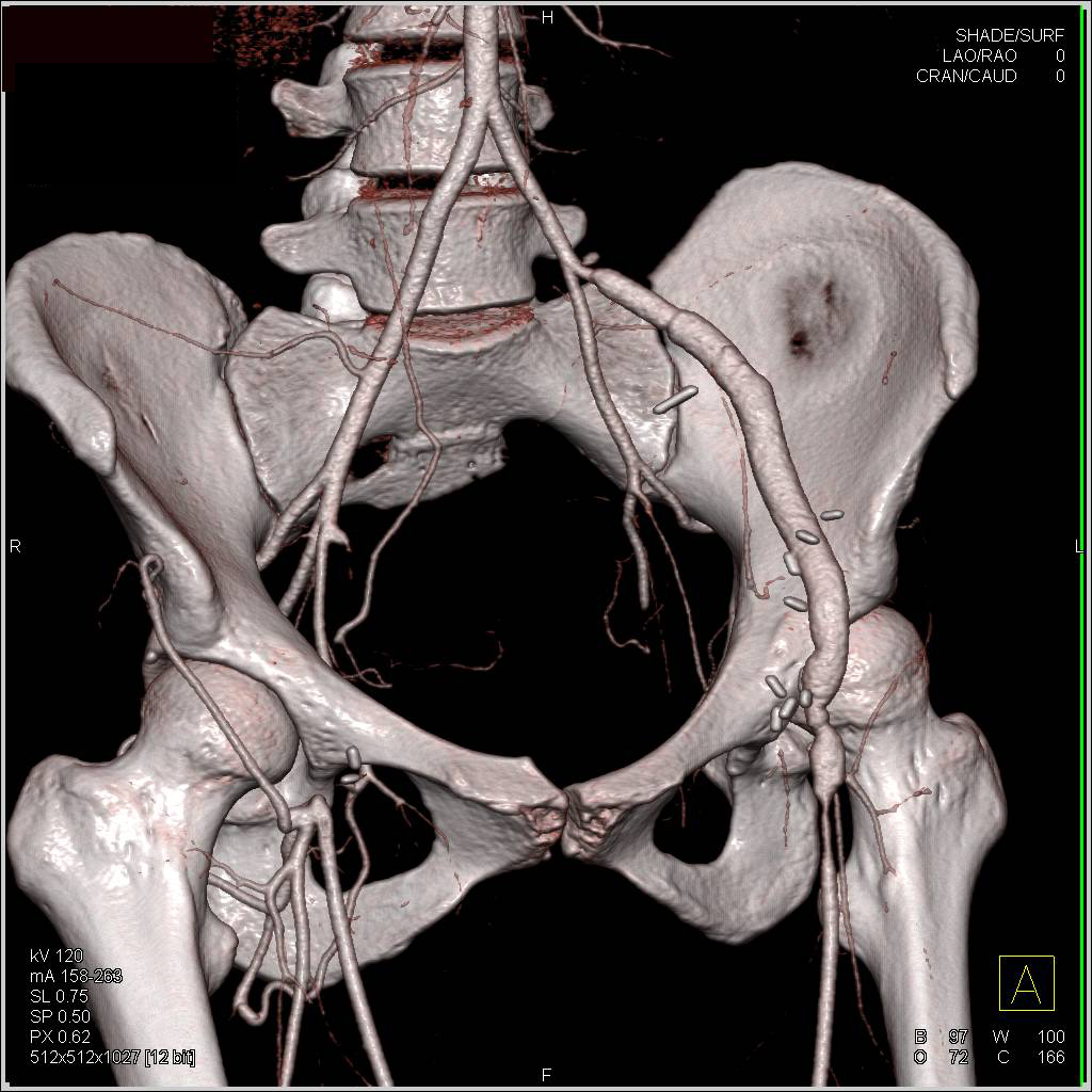 Unusual Vascular Graft from Left Iliac Artery with Stenosis and 3D ...