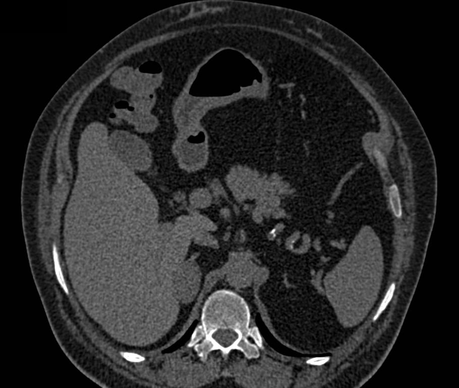 Right Adrenal Adenoma - CTisus CT Scan