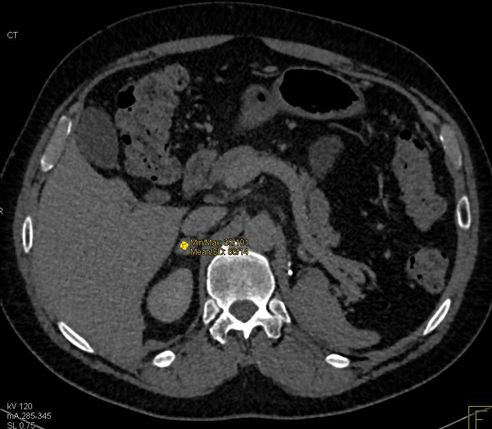 Right Adrenal Metastases from Renal Cell Carcinoma - CTisus CT Scan