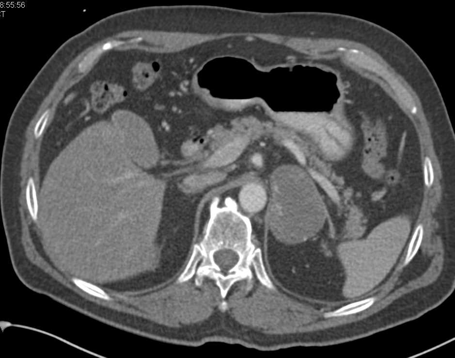 Adrenal Hematoma - CTisus CT Scan