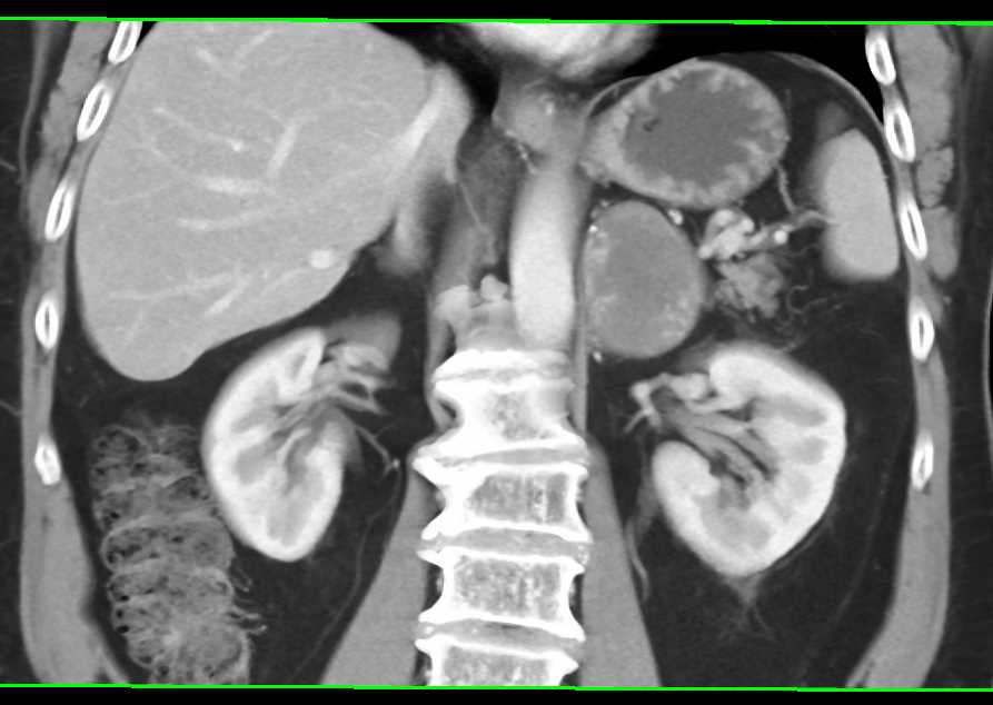 Old Left Adrenal Hematoma - CTisus CT Scan