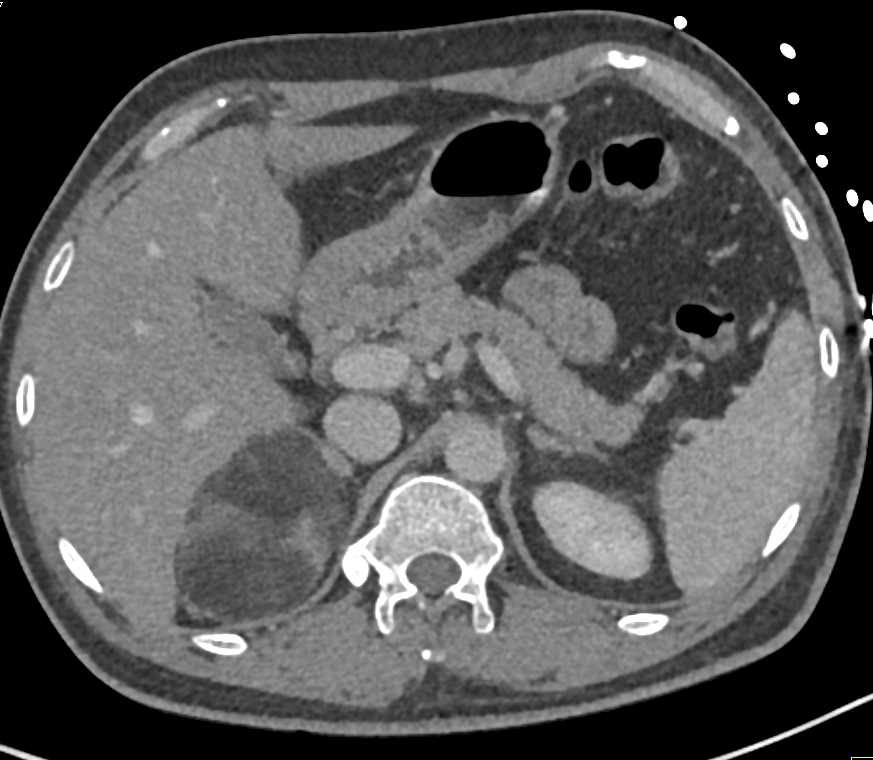 Adrenal Myelolipoma - CTisus CT Scan