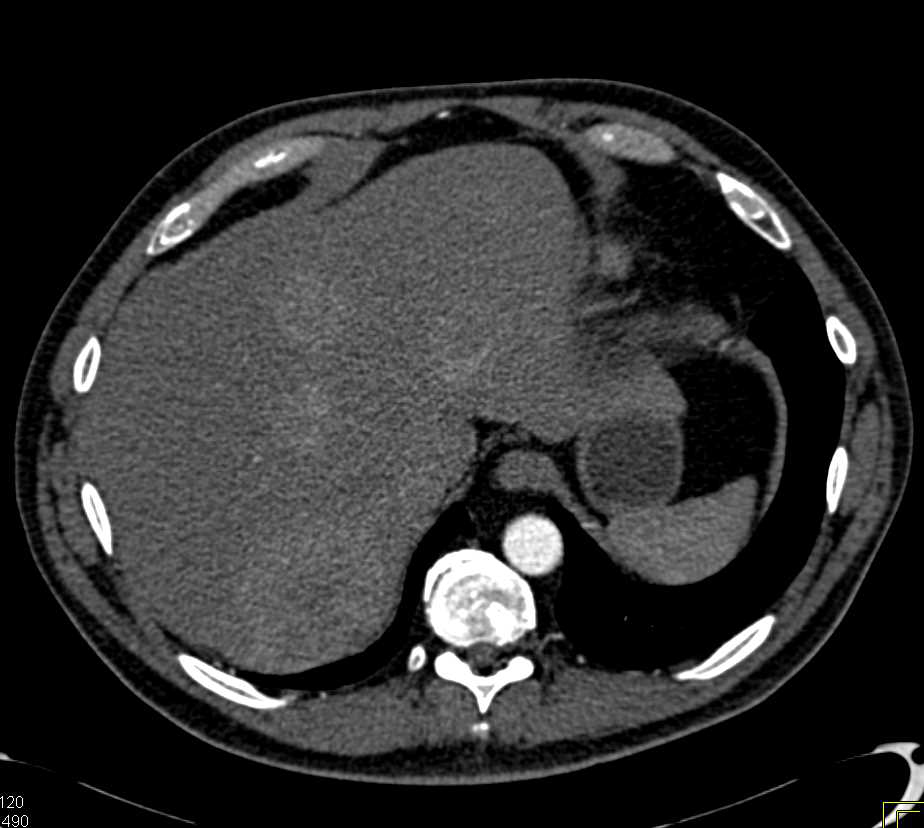 Carcinoid Tumor in the Root of the Mesentery - CTisus CT Scan