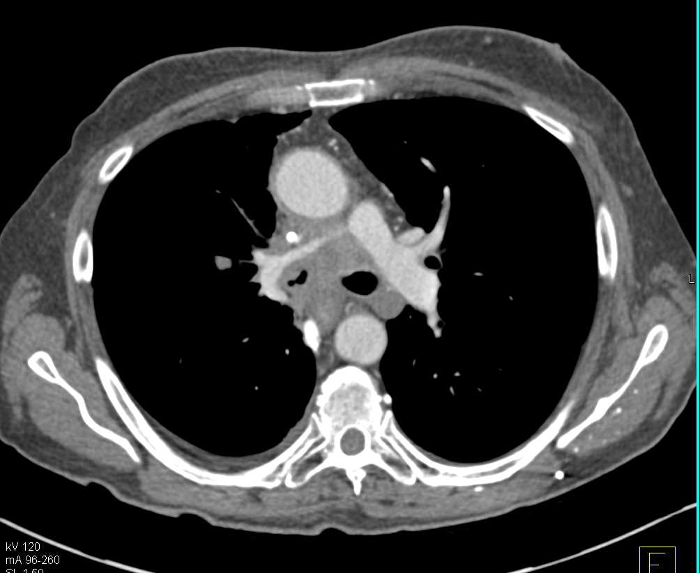 Lymphoma with Extensive Adenopathy and Encasement of the Pulmonary Artery asWell as Adrenal Involvement - CTisus CT Scan