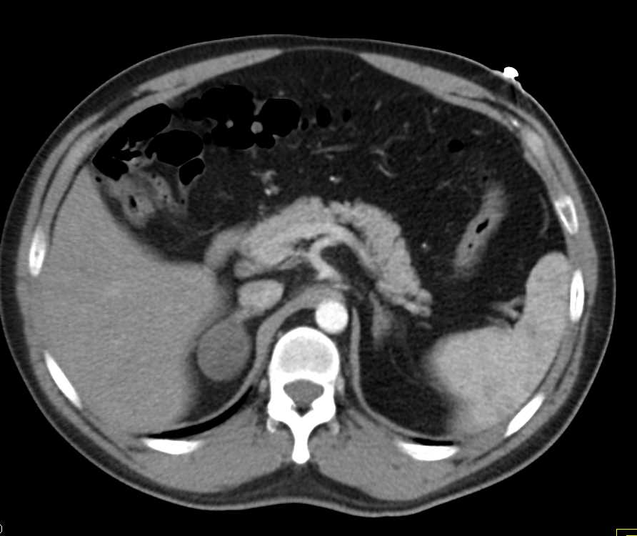 Right Adrenal Adenoma - CTisus CT Scan