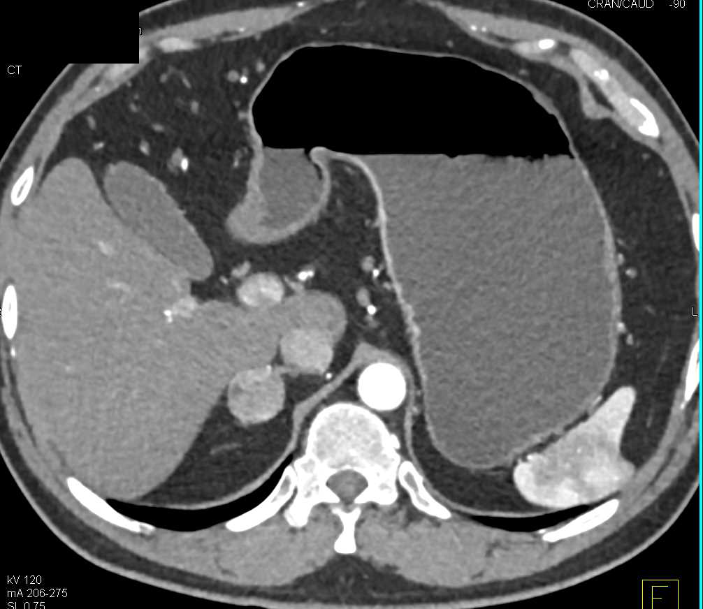 Pheochromocytoma of the Right Adrenal Gland - CTisus CT Scan