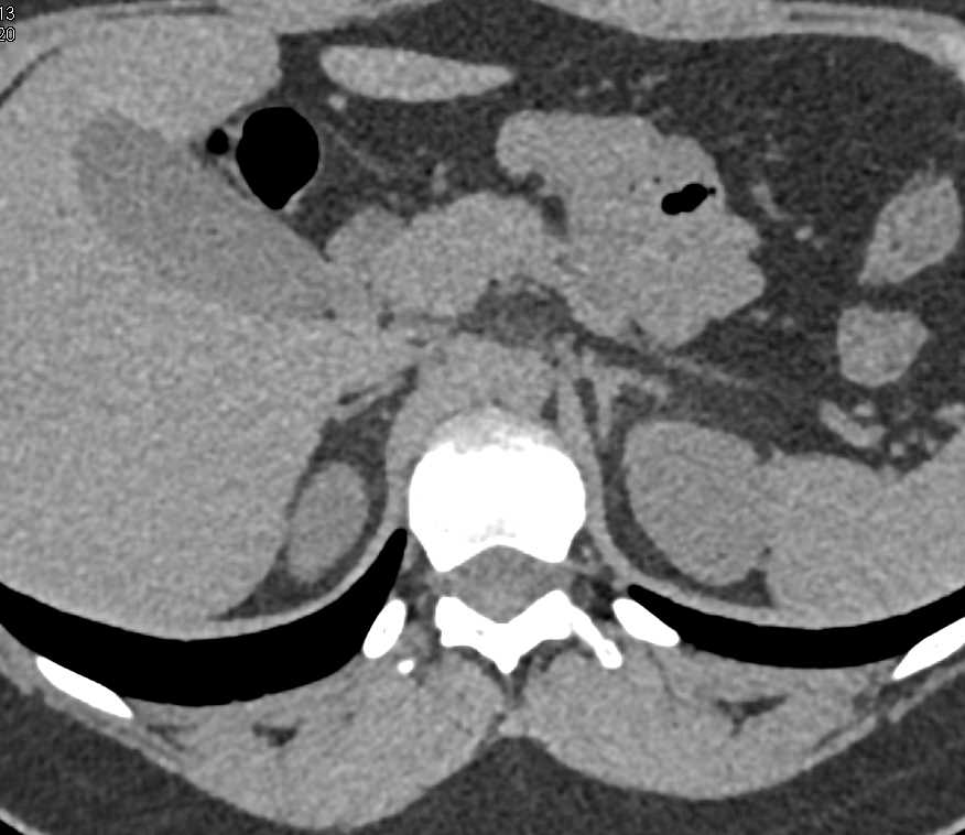 Normal Adrenal Glands - Adrenal Case Studies - CTisus CT Scanning