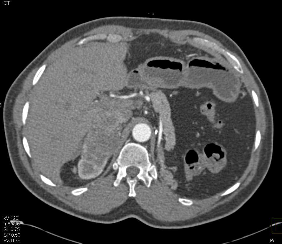 Recurrent Renal Cell Carcinoma Metastatic to the Contralateral Kidney and Adrenal - CTisus CT Scan