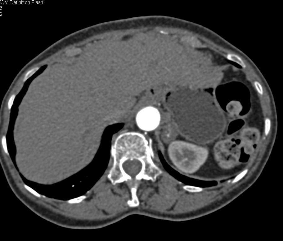 Metastatic Melanoma to Left Adrenal - CTisus CT Scan