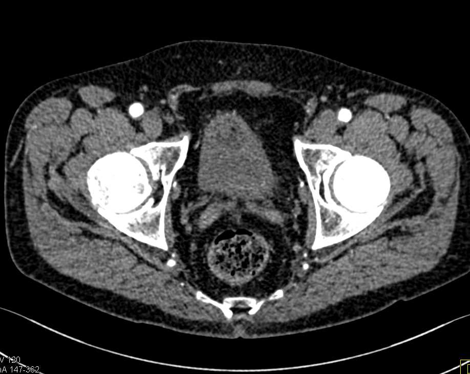 Bladder Cancer - CTisus CT Scan