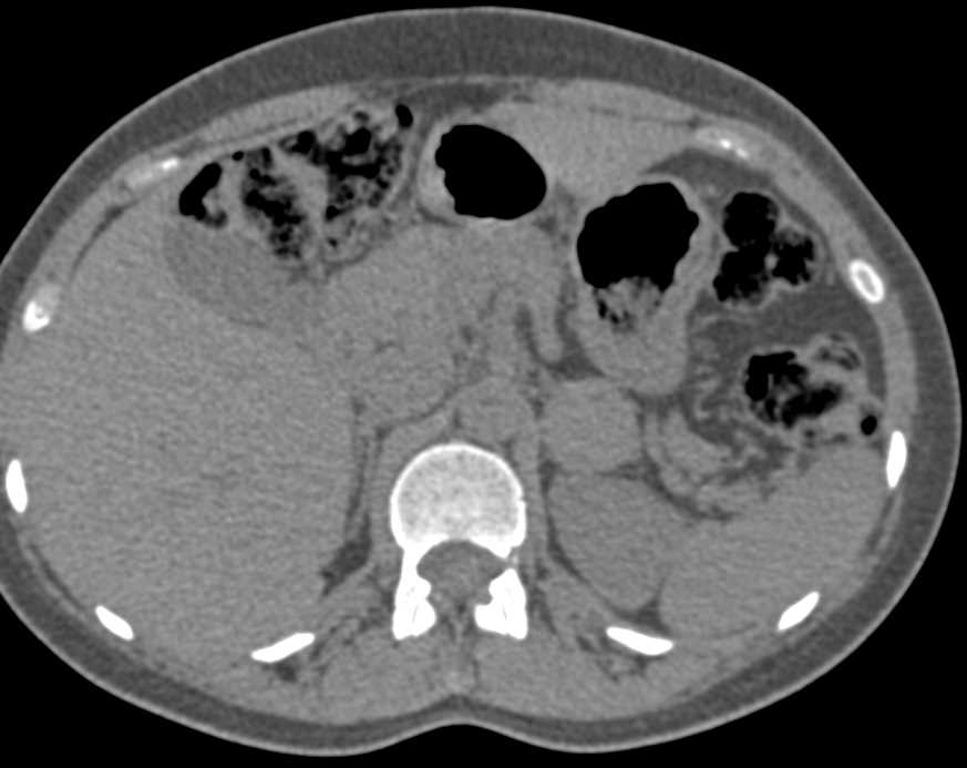 High Density Left Adrenal Adenoma - CTisus CT Scan