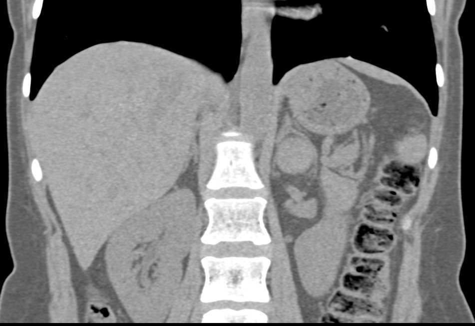 High Density Left Adrenal Adenoma - CTisus CT Scan