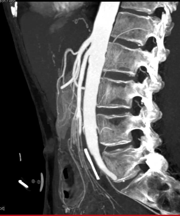 Superior Mesenteric Artery (SMA) Syndrome Based Solely on Patient Symptoms - CTisus CT Scan