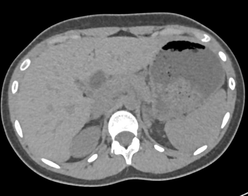 Lipid Poor Adrenal Adenoma - CTisus CT Scan