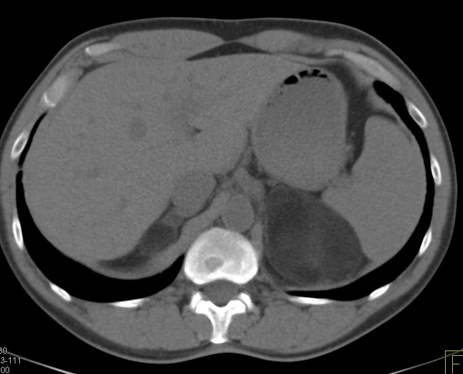 Left Adrenal Myelolipoma - CTisus CT Scan