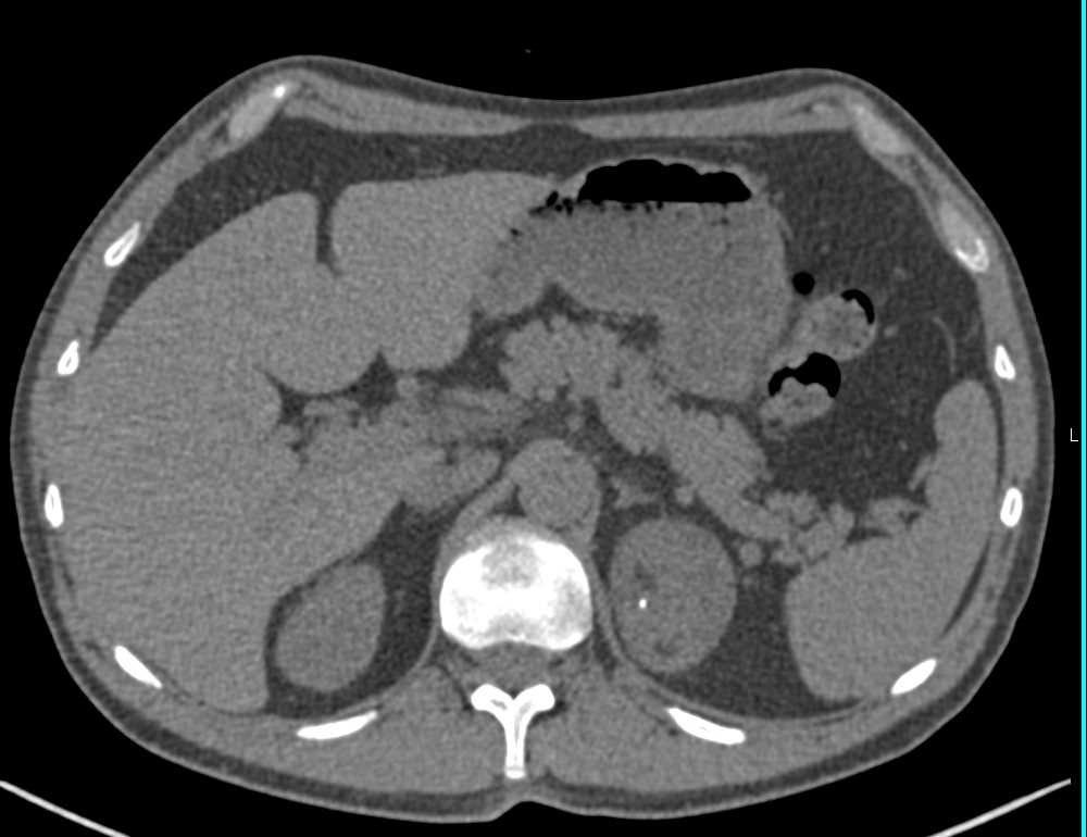 Adrenal Myelolipoma - CTisus CT Scan