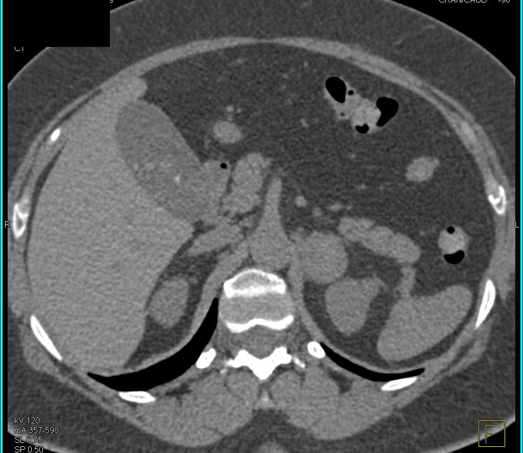 Lipid Poor Adrenal Adenoma - CTisus CT Scan