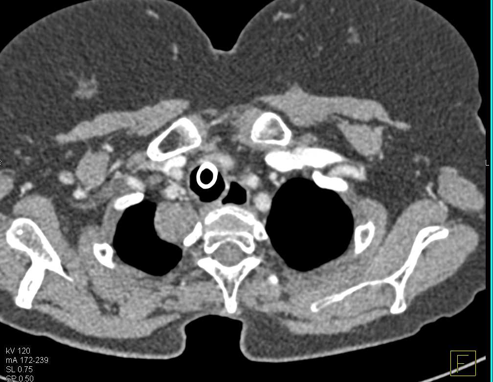 Neurofibroma in the Apex of the Right Lung - CTisus CT Scan