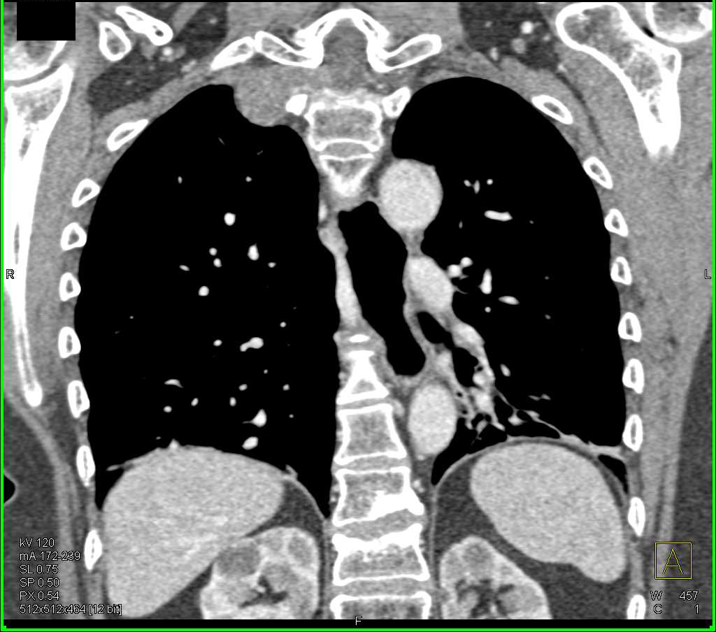 lung apex dead space