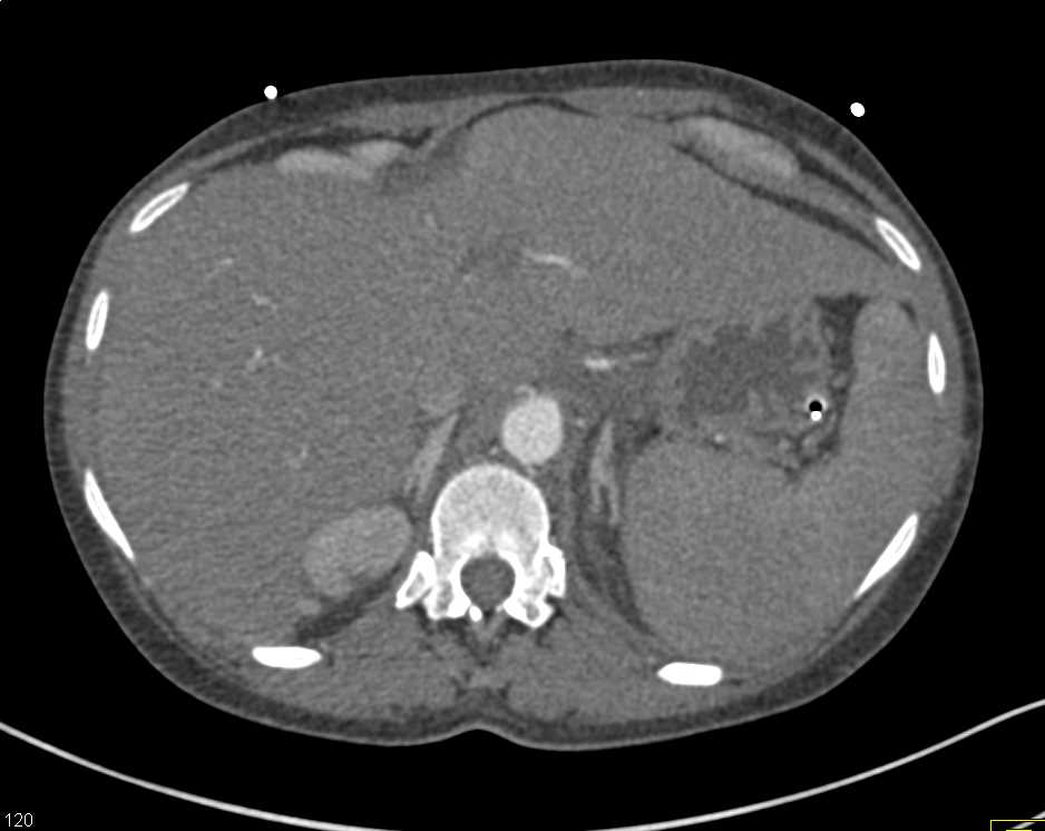 Bright Adrenal Glands in a Trauma Patient - CTisus CT Scan