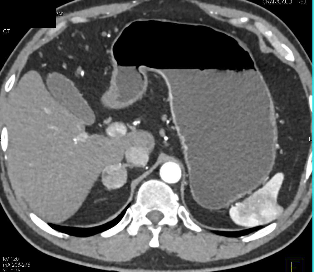 Incidental Pheochromocytoma Right Adrenal Gland - CTisus CT Scan