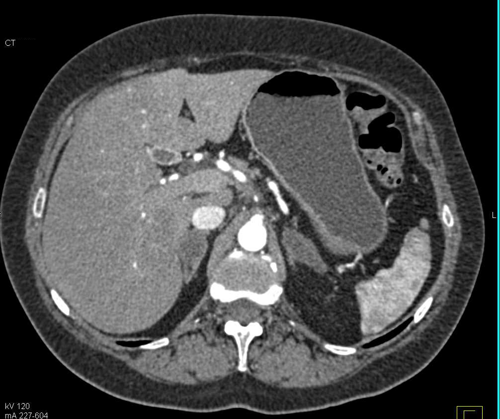 Metastases to the Adrenal Glands and Adenopathy - CTisus CT Scan