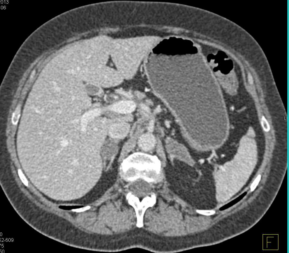 Metastases to Nodes and the Adrenal Glands - CTisus CT Scan