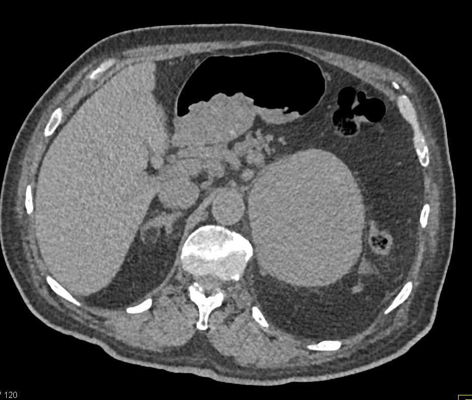 Adrenal Carcinoma - CTisus CT Scan