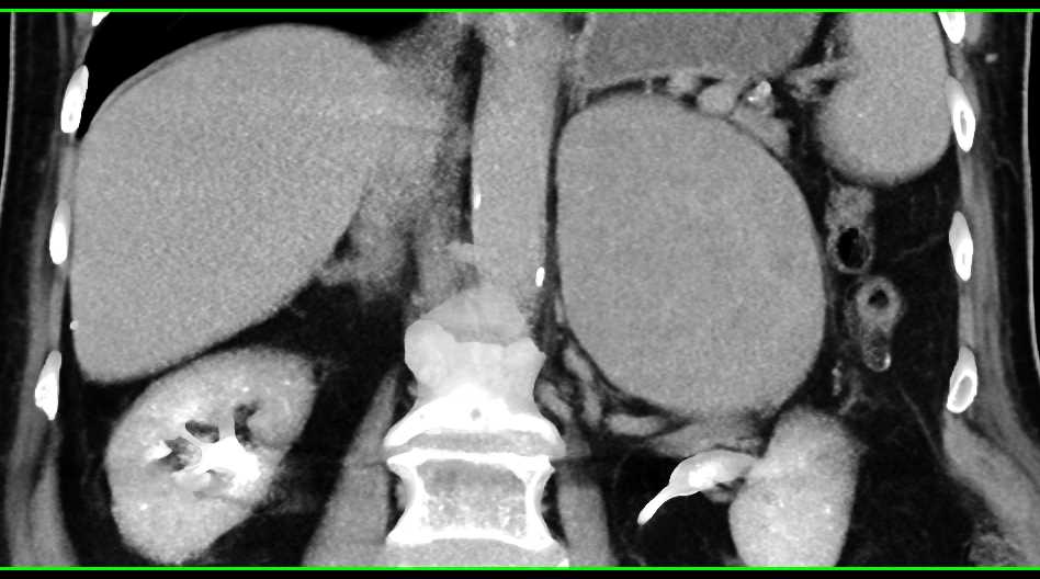 Adrenal Carcinoma - CTisus CT Scan