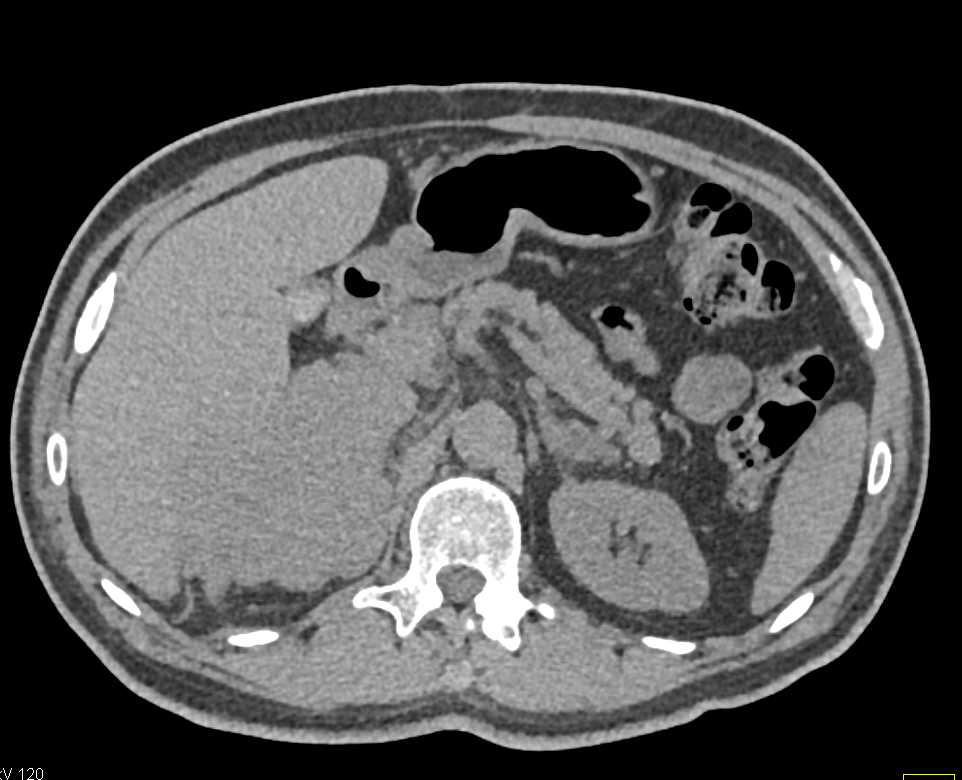 Metastatic Melanoma to the Adrenals and Lung - CTisus CT Scan