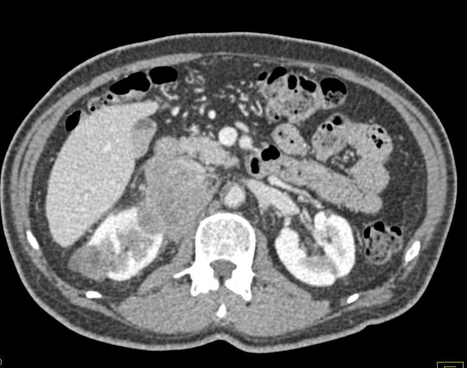 Metastatic Melanoma to the Adrenals with Direct Inferior Vena Cava (IVC) Involvement - CTisus CT Scan