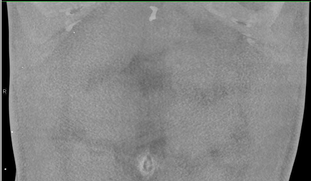 Primary Adrenal Carcinoma - CTisus CT Scan