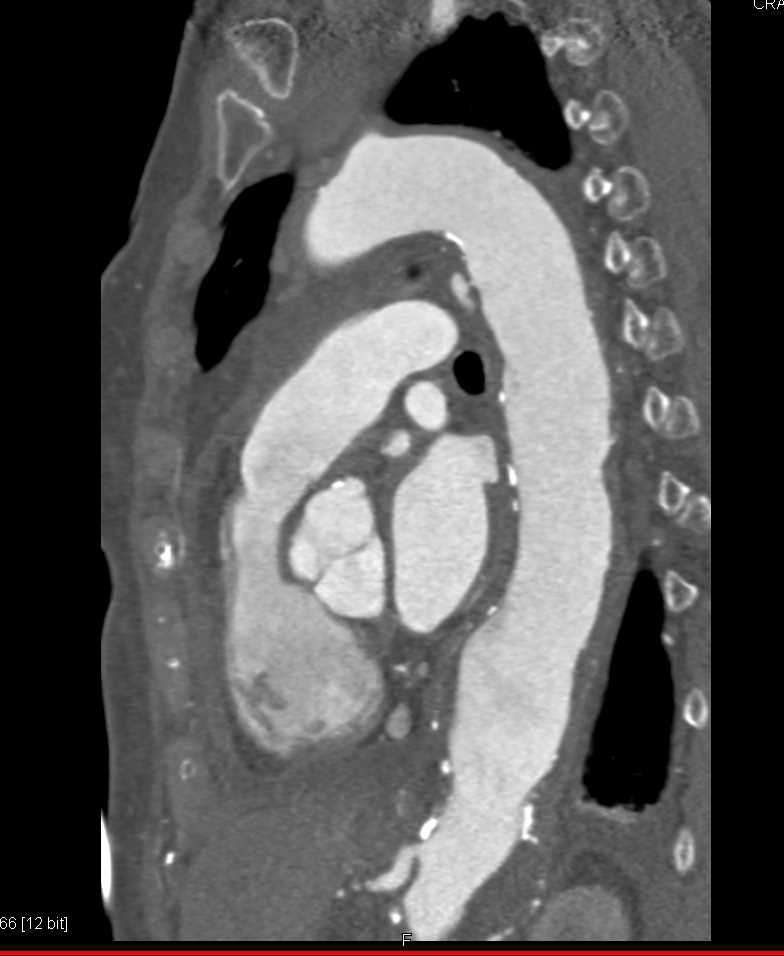 Ulcerating Plaque in Ascending Aorta and Pericardial Effusion - CTisus CT Scan