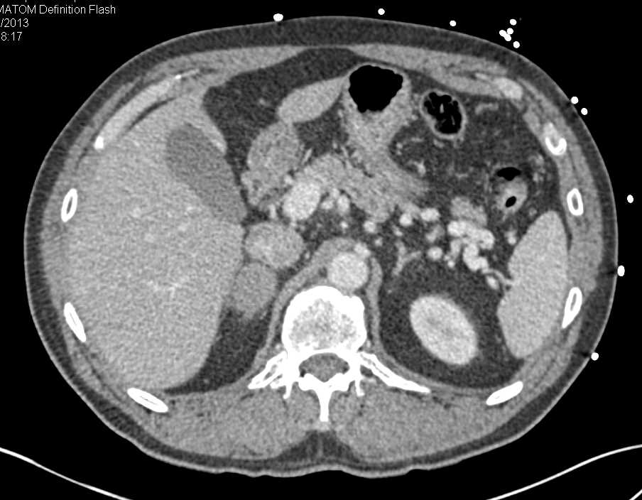 Right Adrenal Adenoma - CTisus CT Scan