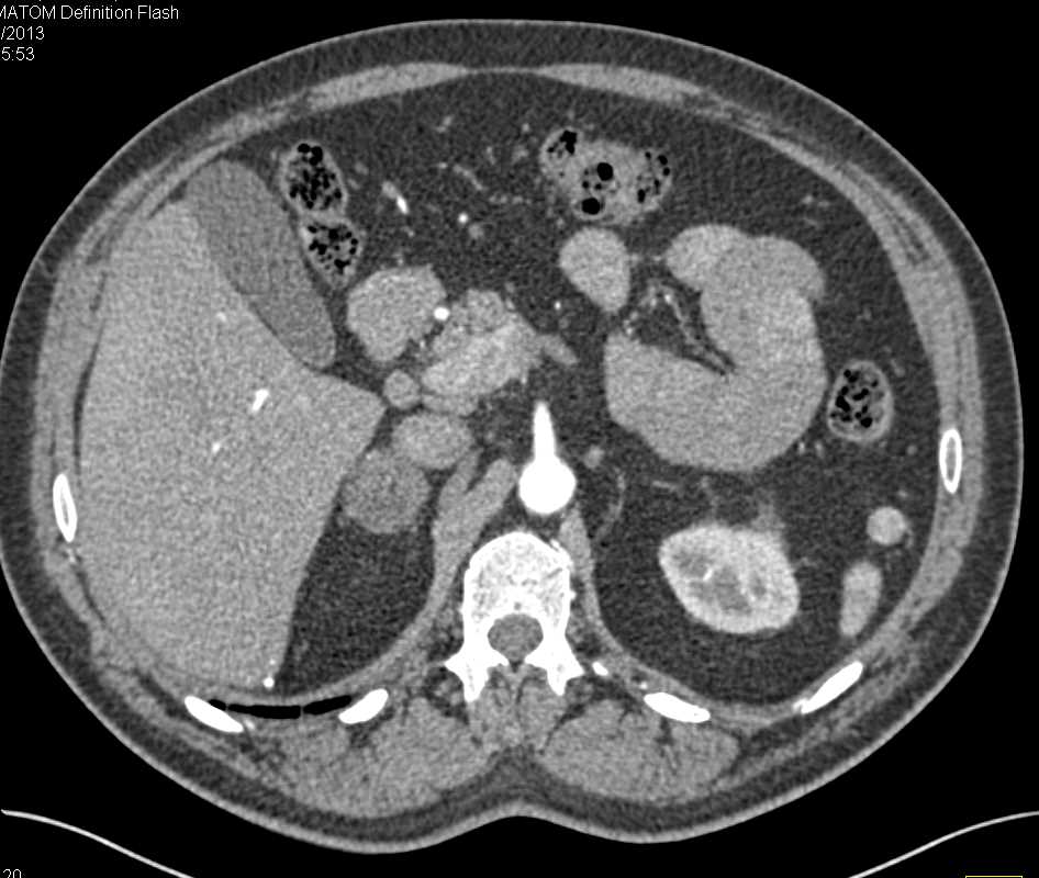 Adrenal Myelolipoma - CTisus CT Scan