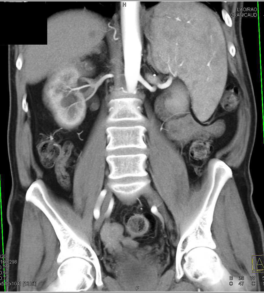 Metastases to the Distal Right Ureter - CTisus CT Scan