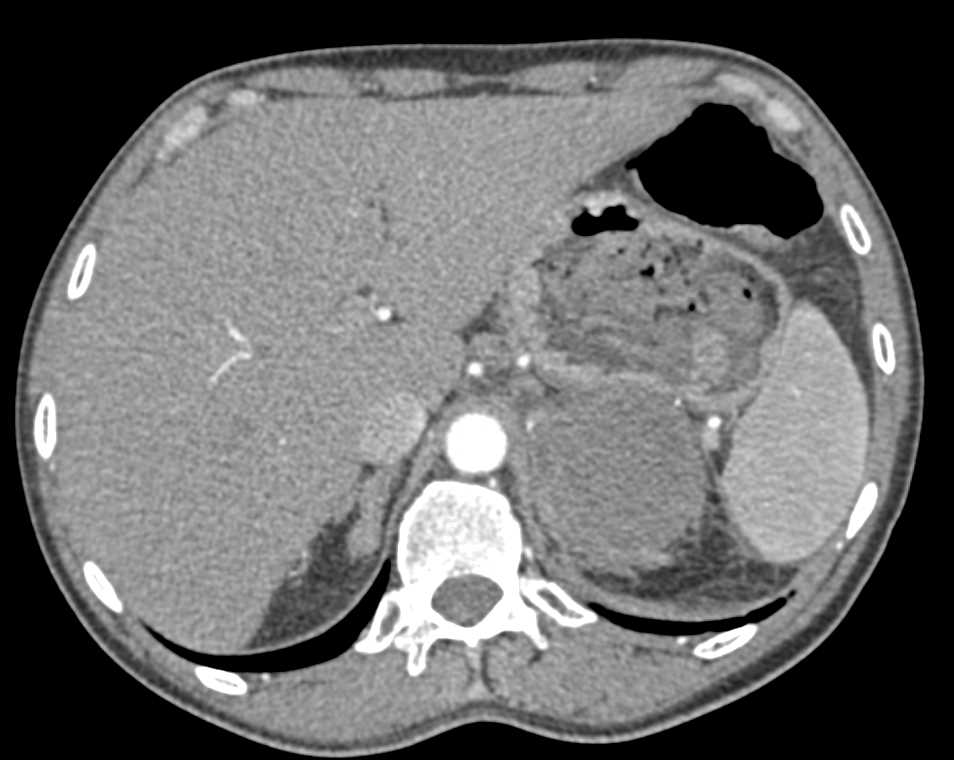 Primary Adrenal Carcinoma with Hemorrhage - CTisus CT Scan