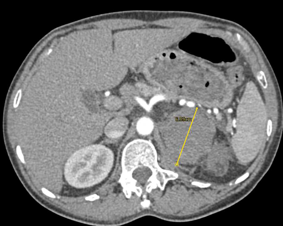 Primary Adrenal Carcinoma with Hemorrhage - CTisus CT Scan