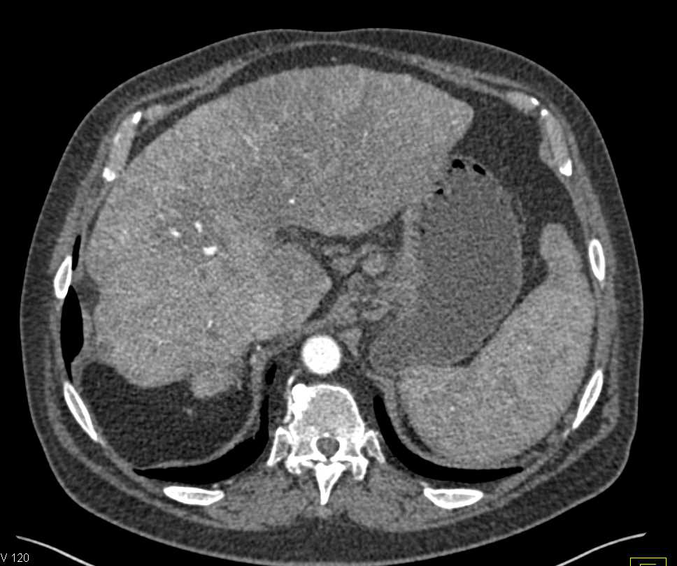 Adrenal Metastases from Hepatocellular Carcinoma (Hepatoma) - CTisus CT Scan