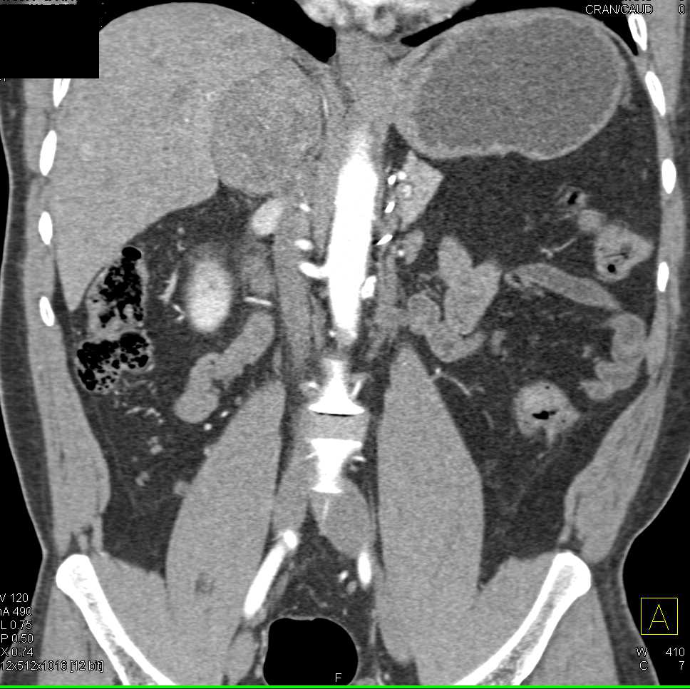 Renal Cell Carcinoma in Contralateral Kidney with Adrenal Metastases as Well - CTisus CT Scan