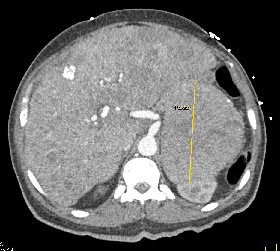 Multifocal Hepatocellular Carcinoma (Hepatoma) with Left Adrenal Metastases - CTisus CT Scan