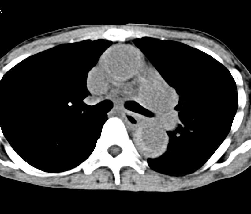 Intramural Hematoma of the Ascending and Descending Aorta - CTisus CT Scan