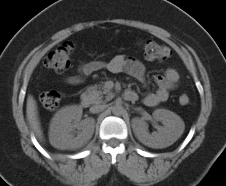 Normal Adrenal Glands - CTisus CT Scan