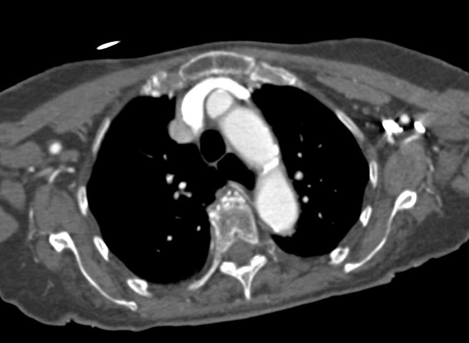 3D Map of Neck Showing Relationship of Thyroid Gland to Arch Vessels - CTisus CT Scan