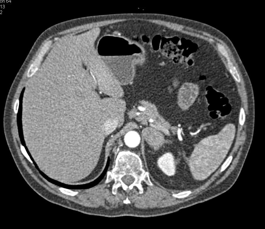 Lymphoma with Adrenal and Liver Involvement - CTisus CT Scan