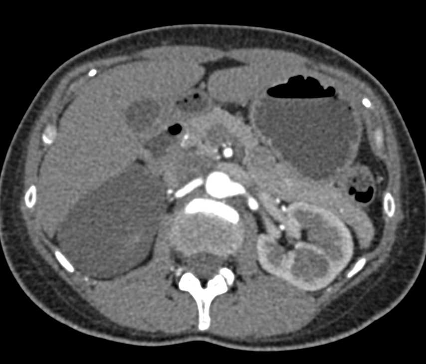 Old Right Adrenal Hematoma - CTisus CT Scan